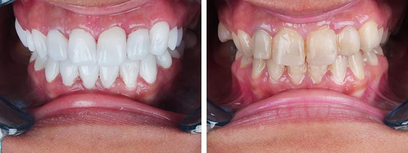 حالة عملية من عيادتنا White & Bright لتبييض الأسنان
