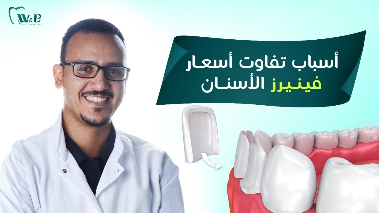 اسعار فينيرز الاسنان