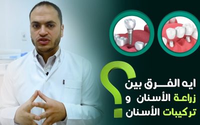 ايه الفرق بين زراعة الاسنان وتركيبات الاسنان؟ | د/ أحمد العايدي